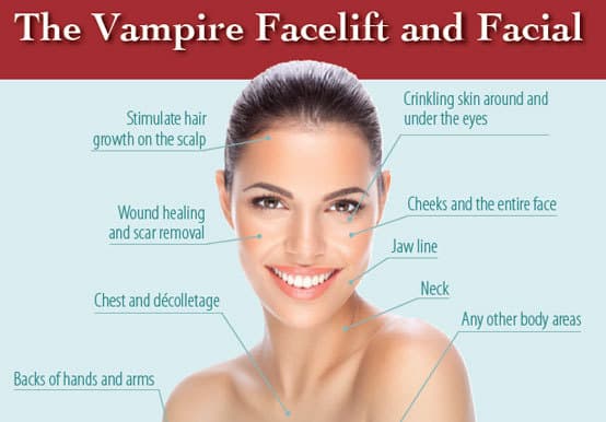 Vampire Facelift PRP therapy